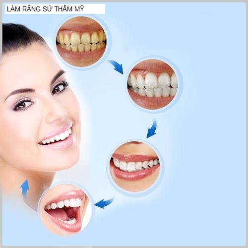 Hình ảnh LÀM RĂNG SỨ THẨM MỸ